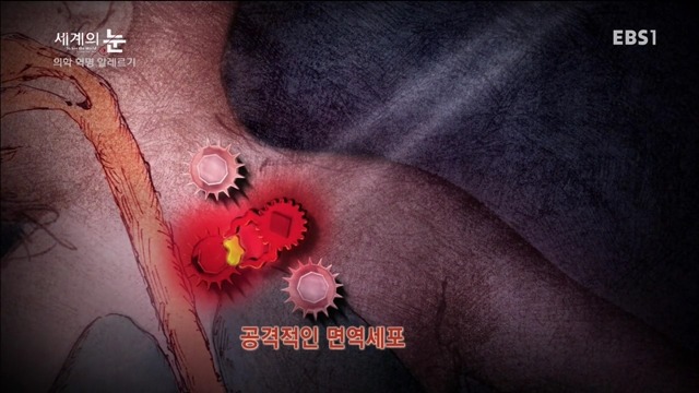 다큐 세계의 눈 - 의학 혁명 알레르기 | 인스티즈