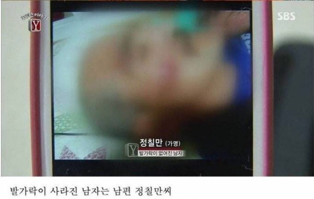 자고 일어나니 발가락이 모두 사라진 남자 | 인스티즈