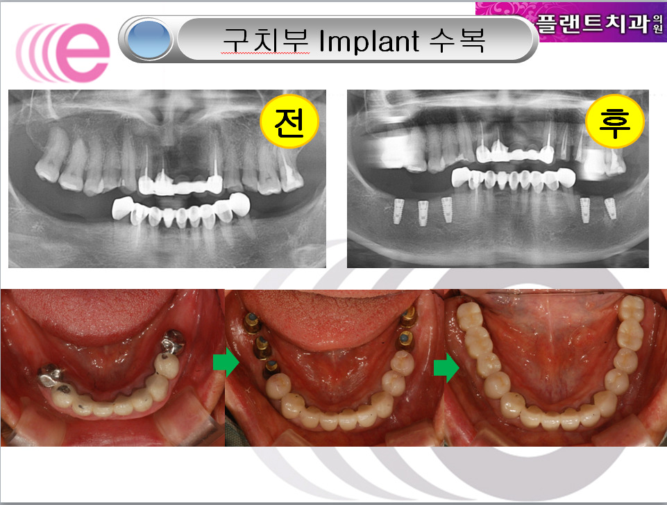e-플랜트치과 이미지