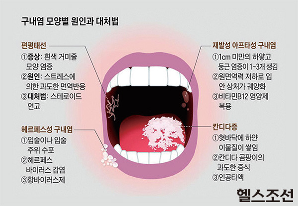 별 거 아닌데 자주 생기고 아픈거.jpg | 인스티즈