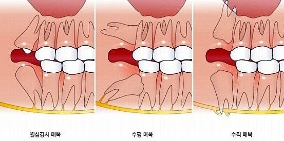 사랑니.gif | 인스티즈