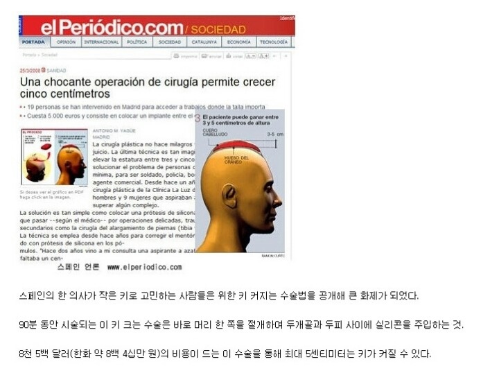 스페인 의사가 제안하는 키 커지는 수술 | 인스티즈