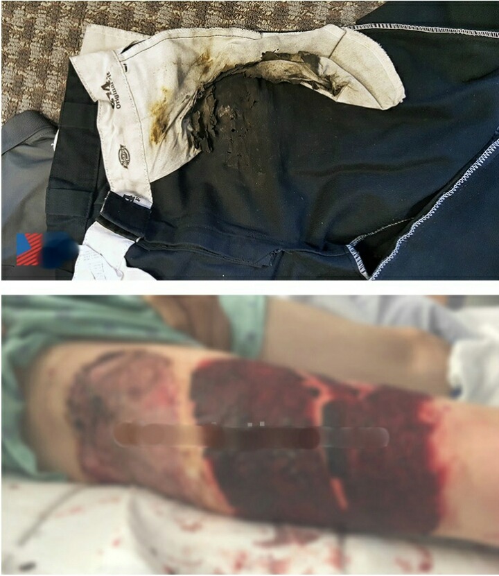 갤럭시 S7 엣지 발화로 인한 화상 사고 발생 (혐오주의) | 인스티즈