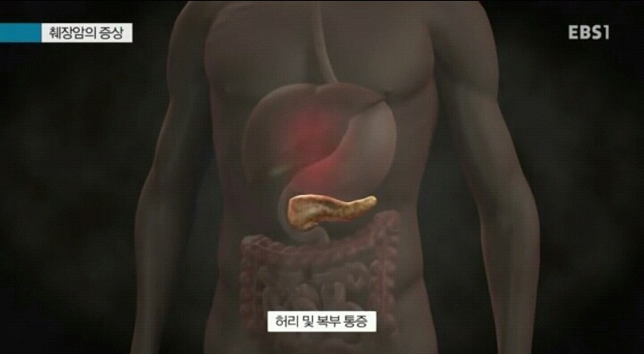 췌장암이 최악의 암으로 불리는 이유.jpg | 인스티즈