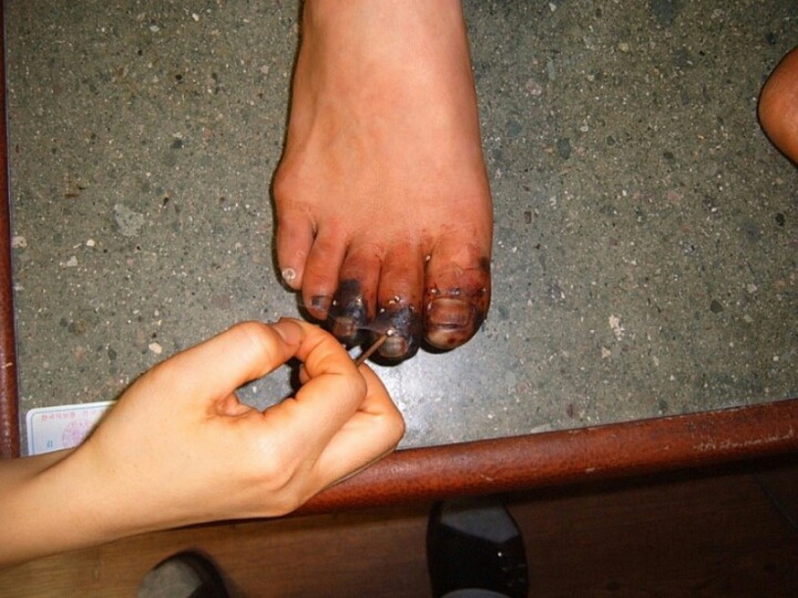 혐)주작 말 나오던 동상환자 침 치료 후기..jpg | 인스티즈