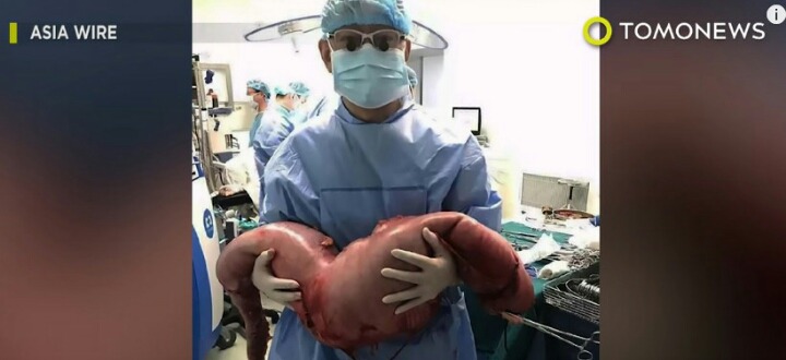 혐주의)변비 걸린 남성의 장을 절제해보니 무게가 13kg | 인스티즈